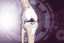 Personalized Precision in Knee Replacement