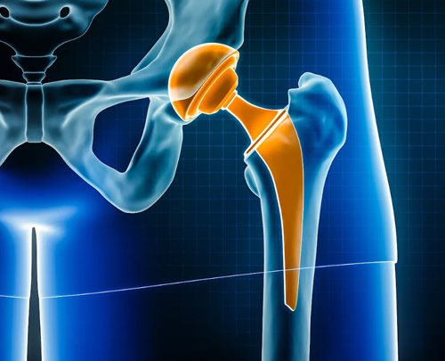 Is Joint Replacement the Best Treatment Option for Arthritis Pain